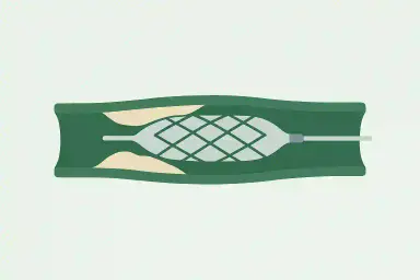 Angioplasty