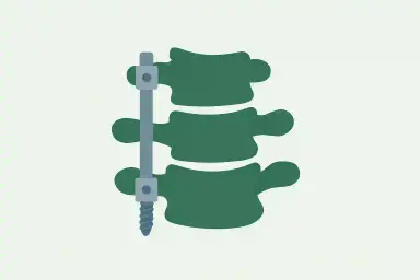 Spine Surgery